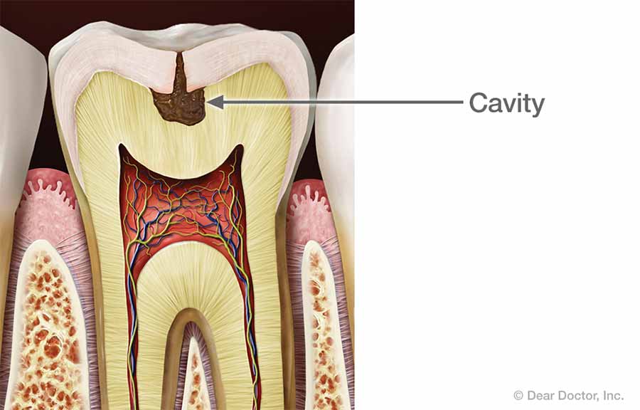 Cavity.